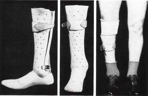 amputation and prothesis amputation and prothesis