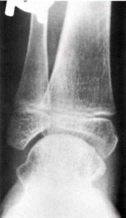 Fig. 6. The "ball-and-socket" ankle joint prod | O&P Digital Resource