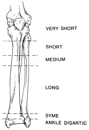 transtibial amputation