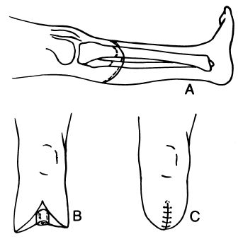 transtibial amputation
