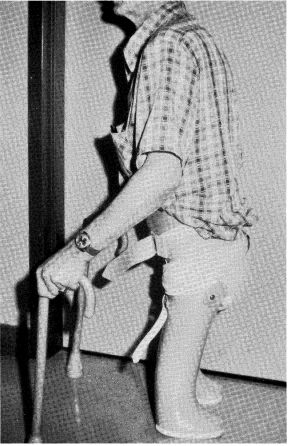 Fig 24A-21. A 72-year-old male with bilateral | O&P Digital Resource Library