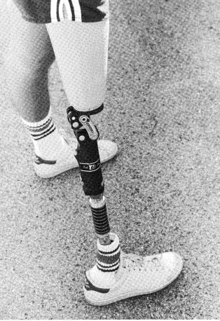 Fig 24B-17. Terry Fox running prosthesis. (Cou | O&P Digital Resource  Library