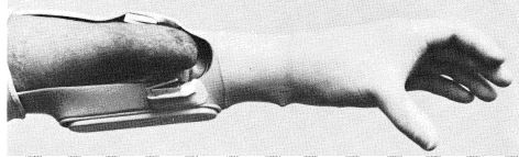 Krukenberg Hands