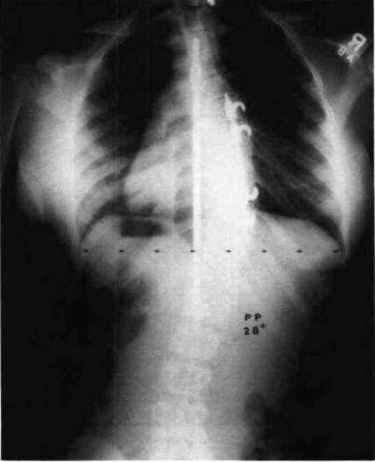 Figure 4. Xray showing Harrington rod system. O&P Digital Resource