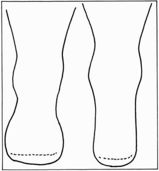 Figure 4. Left, a bulbous residual limb after O&P Digital Resource