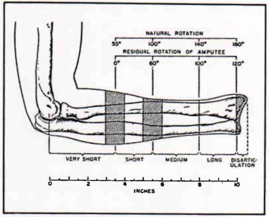 Figure 15 Below elbow Amputee Types Based On O P Digital Resource 