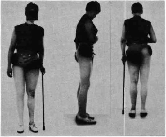 Hip+Disarticulation+Prosthetic Fig. 10. Hip disarticulation prosthesis with m | O&P Digital Resource ...