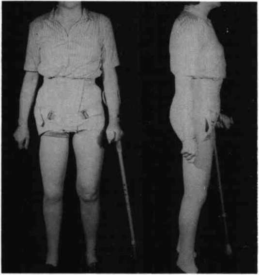 Hip+Disarticulation+Prosthetic Hip Disarticulation Prosthetic http://www.oandplibrary.org/popup.asp ...