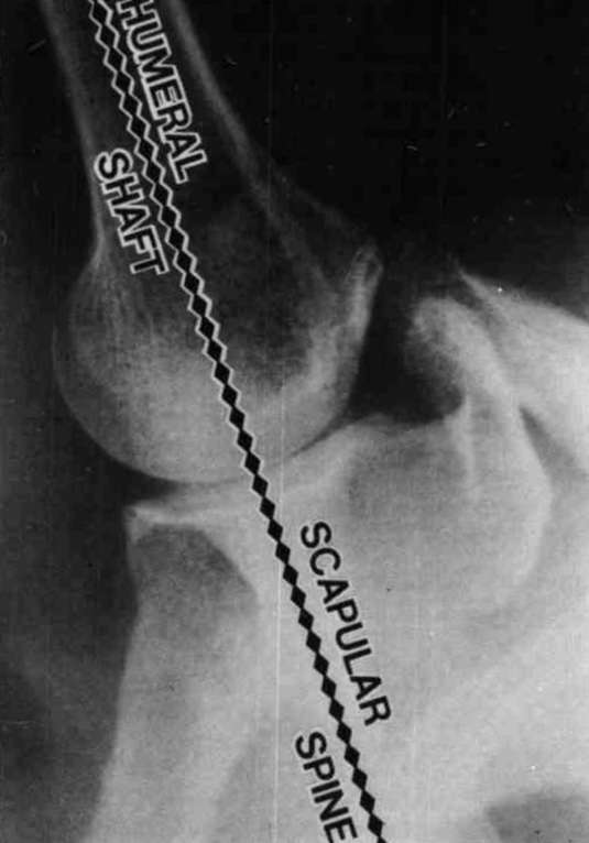 Fig. 2. Radiograph showing the normal shoulder O&P Digital Resource
