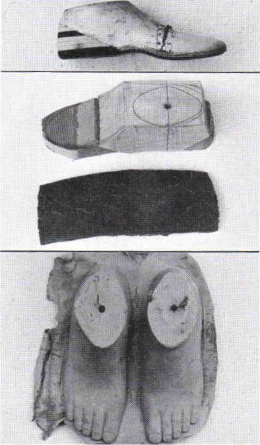Fig. 4. Top, locally made wooden SACH foot. Ce O&P Digital Resource