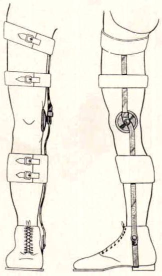 Figure 11. Single bar long leg brace. | O&P Digital Resource Library